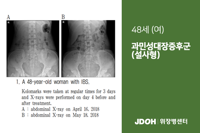 수술후기 이미지